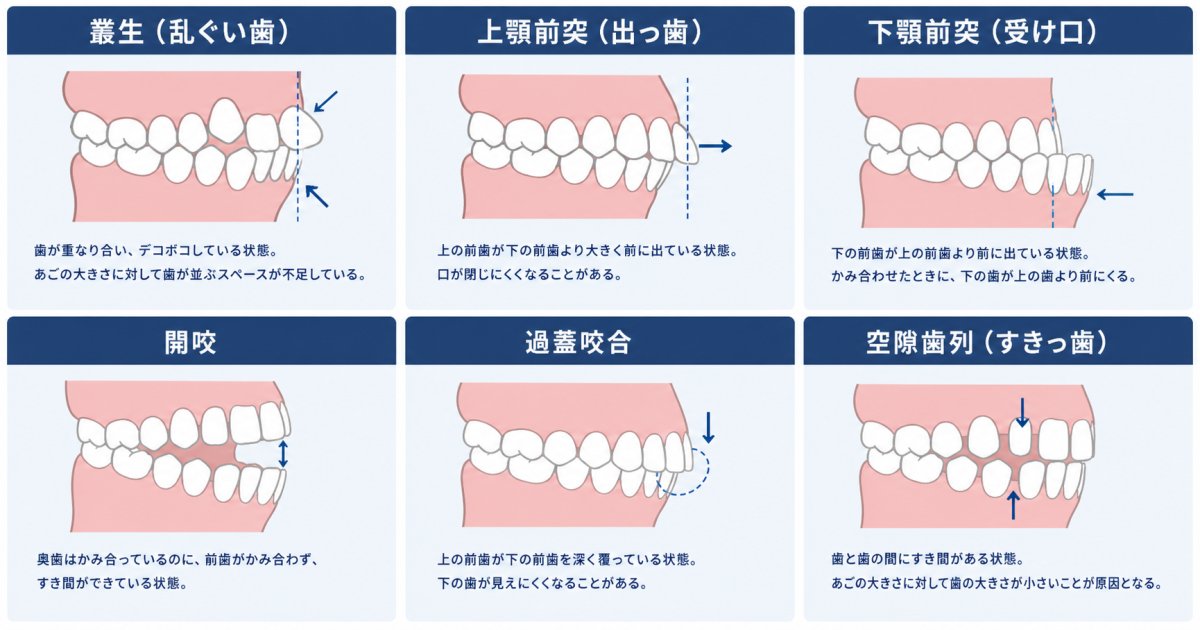 代表的な悪い歯並び（不正咬合）の6つの種類と口内の特徴