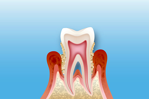 歯周再生療法
